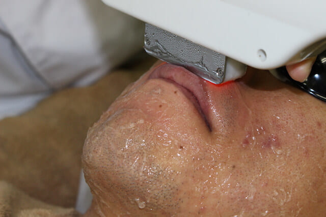 メンズクリア 鼻下