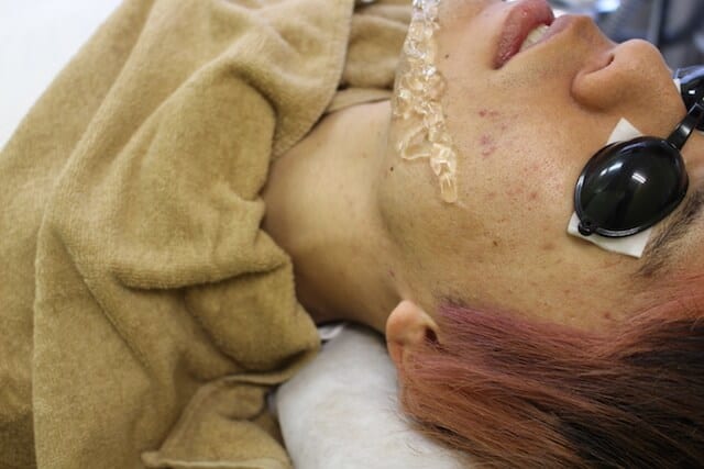 メンズクリア 照射前2