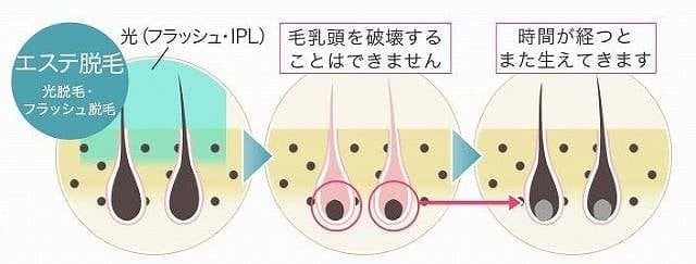 エステ脱毛　ipl方式