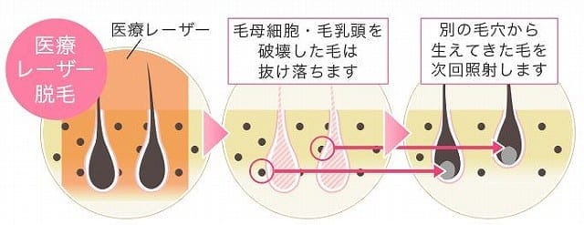 医療脱毛　レーザー方式